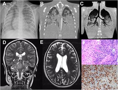 Two <mark class="highlighted">Brothers</mark> with Atypical UNC13D-Related Hemophagocytic Lymphohistiocytosis Characterized by Massive Lung and Brain Involvement